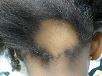 Alopecia areata